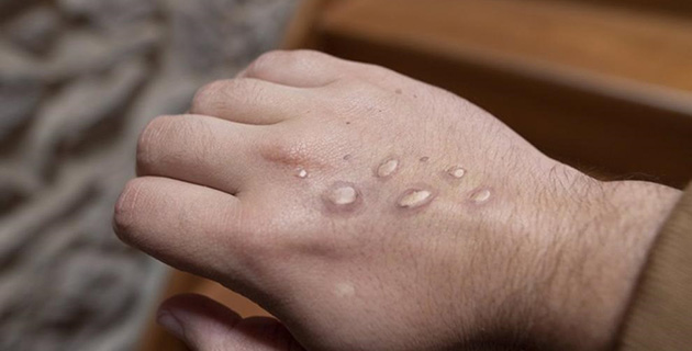 Confirman el primer caso de viruela del mono en el partido de Escobar