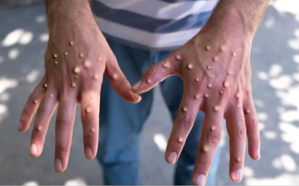 Viruela del mono en Escobar: confirman el primer caso en Maquinista Savio