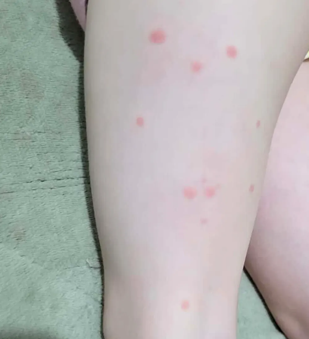picaduras en una pierna de una nena causadas por las pulgas