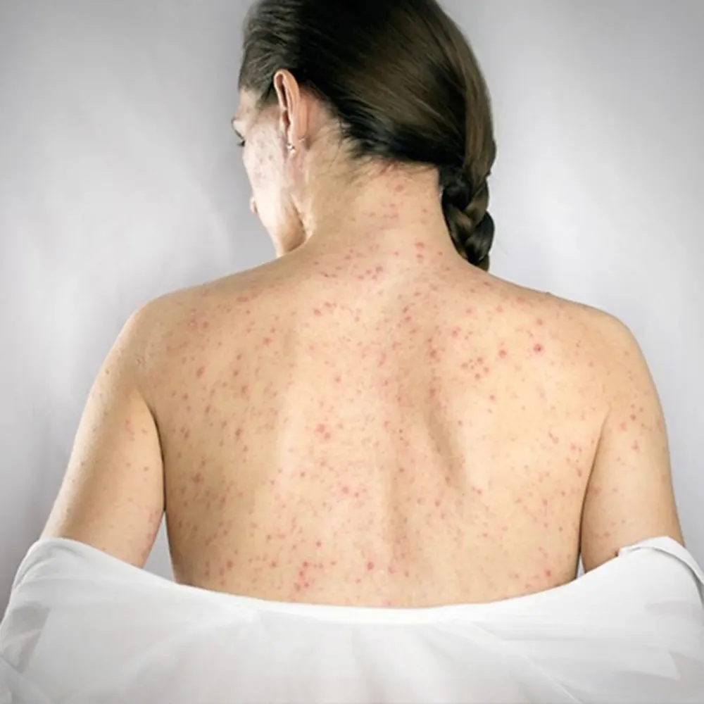 Erupciones en la piel de una mujer por S&iacute;filis.