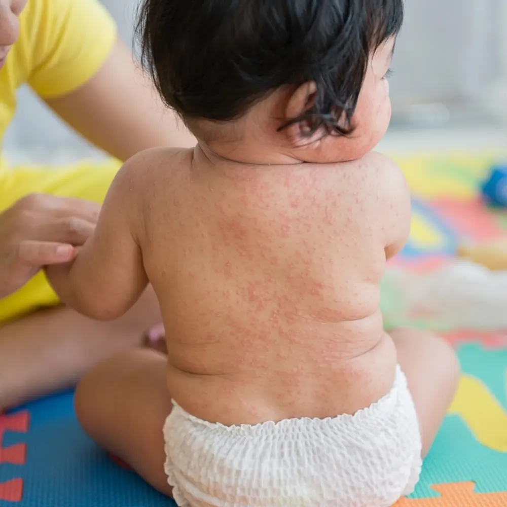 Uno de los s&iacute;ntomas de meningitis son las manchas rojas en la piel.